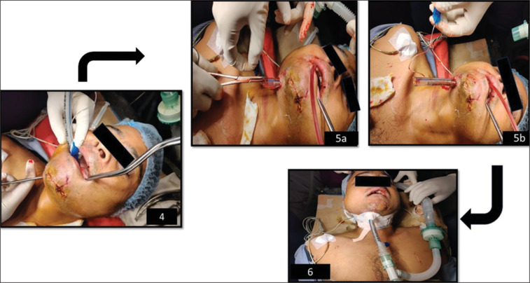 A new safer method for extubating patients of submental intubation - A case report.