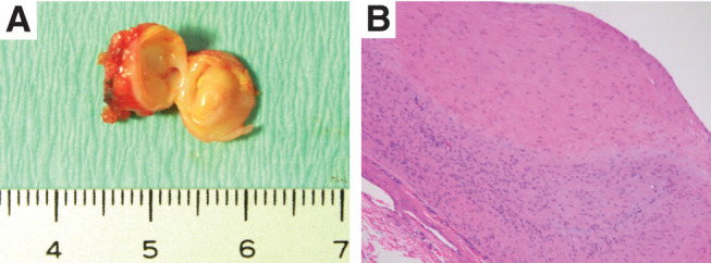 Laparoscopic Resection of an Unruptured Aneurysm of the Right Gastric Artery.
