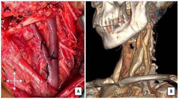 Fenestration and Bifurcation of the Internal Jugular Vein; Surprises During Head and Neck Surgery.