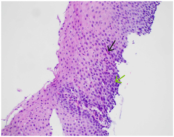 Idiopathic Secondary Eosinophilia: Revealing Cerebral Aneurysms as a Vascular Complication.