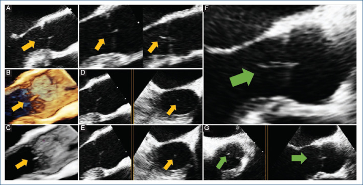 Lambl's excrescence on the aortic valve.