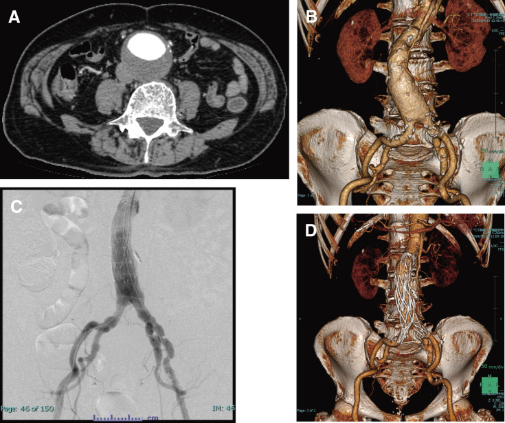 Abdominal Aortic Aneurysm with Primary Cold Agglutinin Disease Treated with Endovascular Aortic Repair.