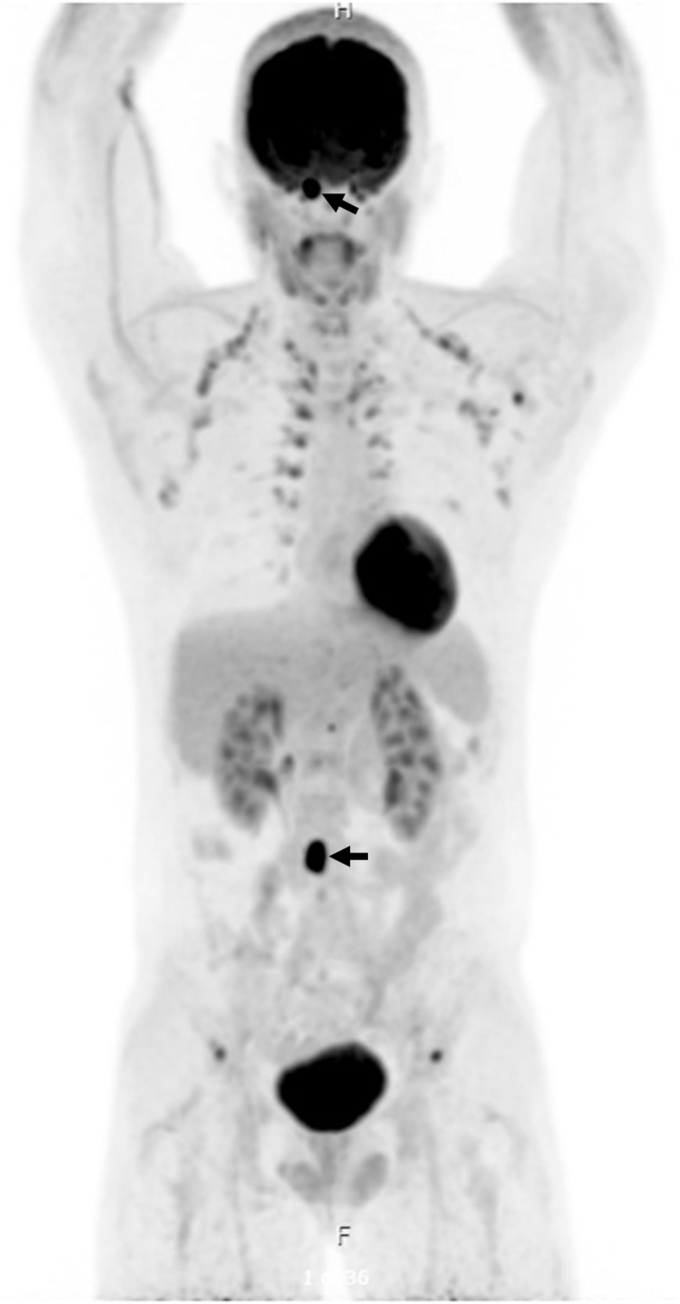 Malignant Paraganglioma With Calvarial Metastases Presenting With Recurrent Catecholamine-Induced Cardiomyopathy