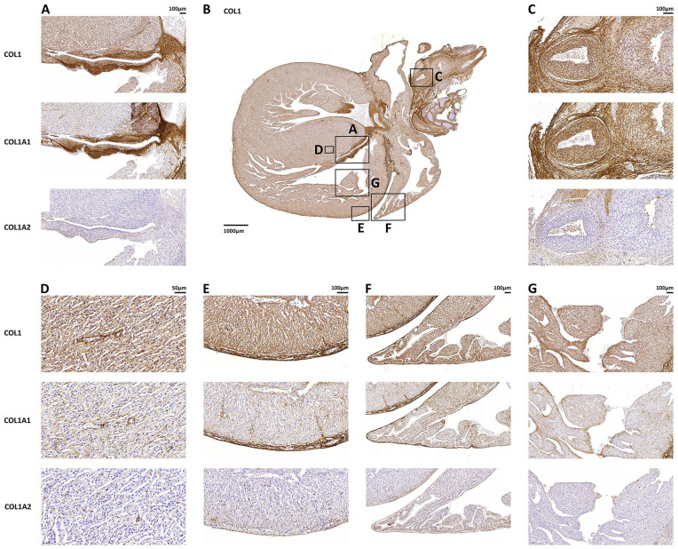Case Series of 6 Fetuses With Osteogenesis Imperfecta Type II: A Retrospective Study of Heart Pathology.