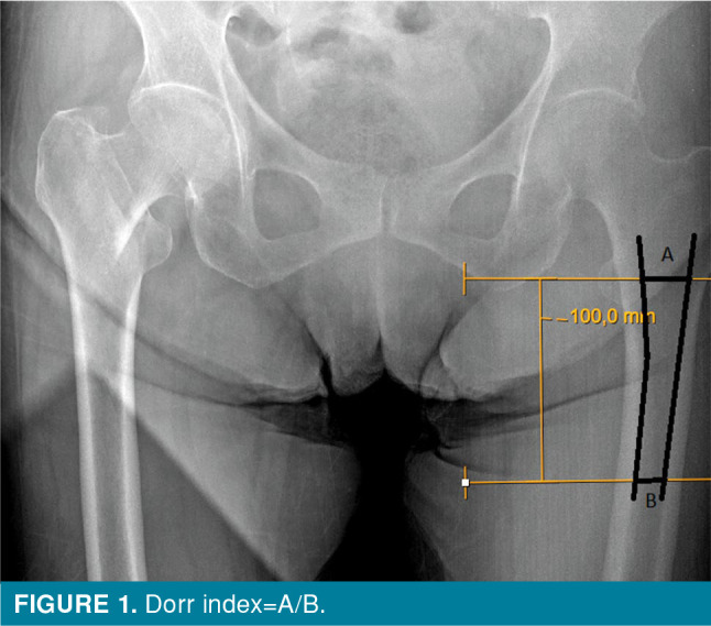 Effectiveness of the Dorr index in predicting implant failure before proximal femoral nail application.