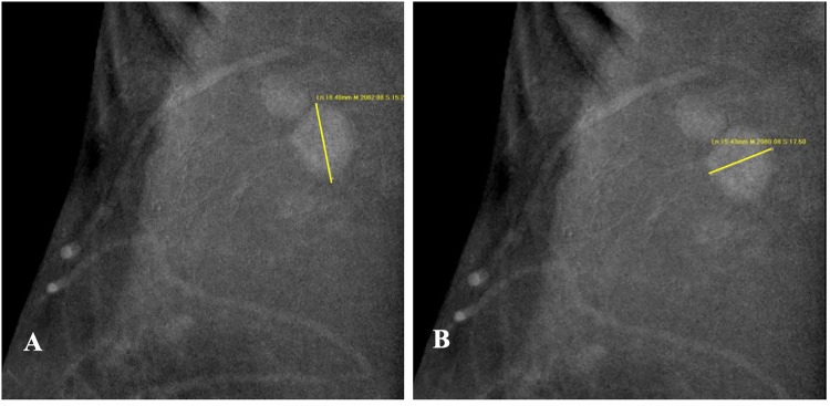 Enhancing Specificity in Predicting Axillary Lymph Node Metastasis in Breast Cancer through an Interpretable Machine Learning Model with CEM and Ultrasound Integration.