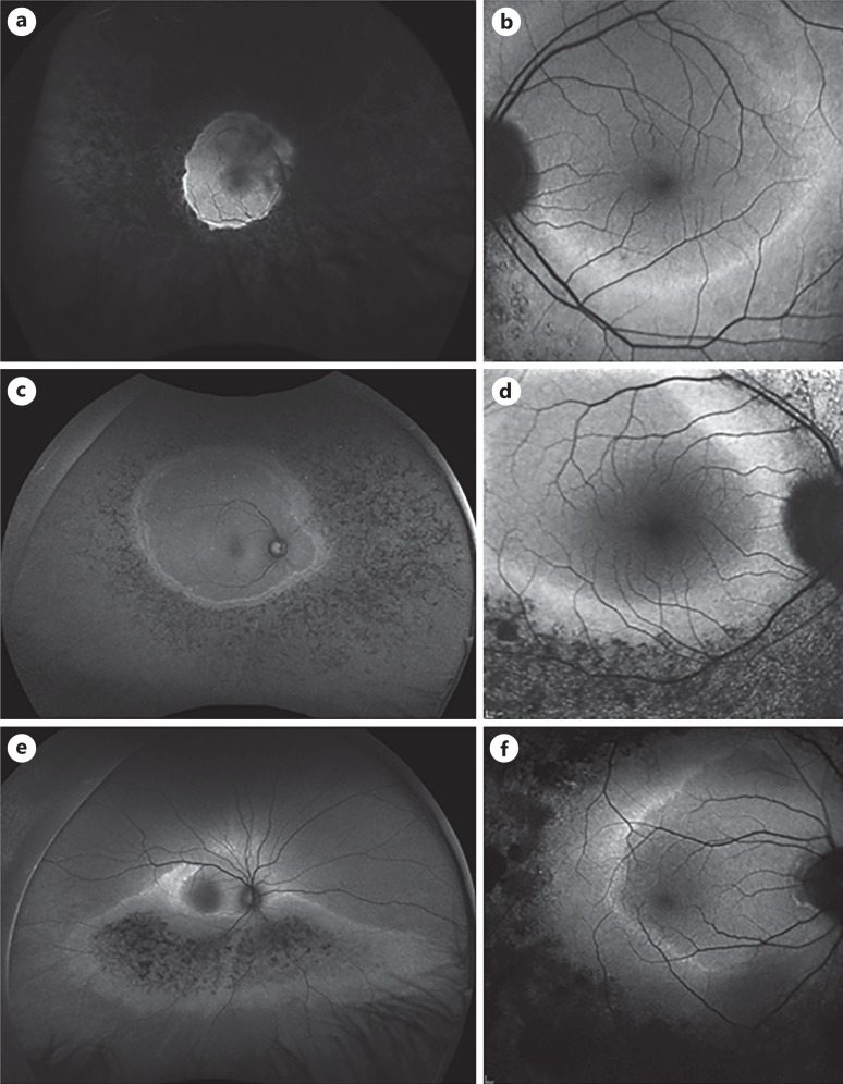 Characterization of Macular Fundus Autofluorescence Changes in Patients with Retinitis Pigmentosa.