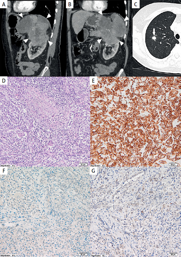 Rare presentation of pancreatic carcinoma mimicking advanced renal cell carcinoma.