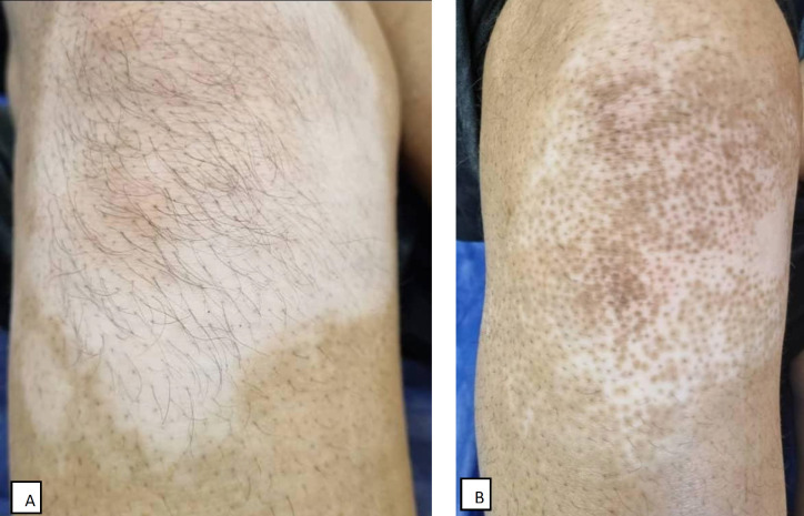 Enhancing Repigmentation in Vitiligo: A Comparative Clinical Trial of Microneedling with Topical 5-Fluorouracil, Fluocinolone, and Microneedling Alone.