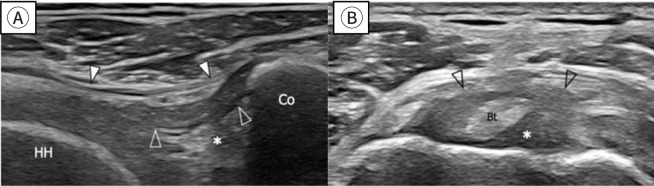 Radiological characteristics of shoulder diseases in older adults, including adhesive capsulitis, rotator cuff tear, and osteoarthritis of the glenohumeral joint: a narrative review.