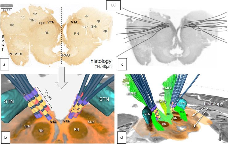 Joint Anatomical, Histological, and Imaging Investigation of the Midbrain Target Region for Superolateral Medial Forebrain Bundle Deep Brain Stimulation.