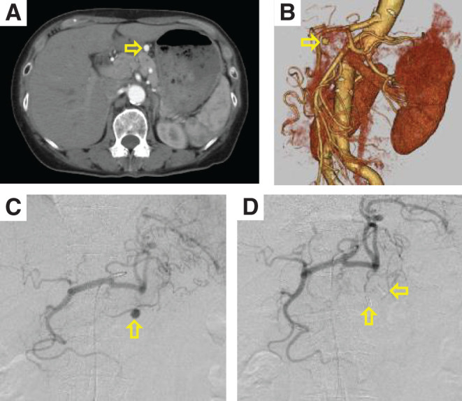 Laparoscopic Resection of an Unruptured Aneurysm of the Right Gastric Artery.