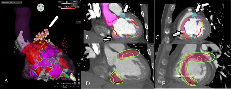 Stereotactic arrhythmia radioablation for ventricular tachycardia: a review of clinical trials and emerging roles of imaging.