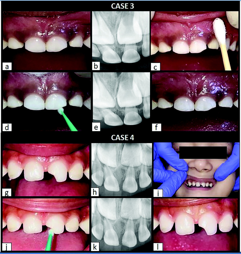 Application of Silver Diamine Fluoride in Dental Trauma: A Case Series Study.