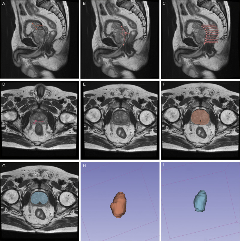 Clinical-radiomics combination model for predicting the short-term efficacy of bipolar transurethral enucleation of the prostate in patients with benign prostatic hyperplasia.