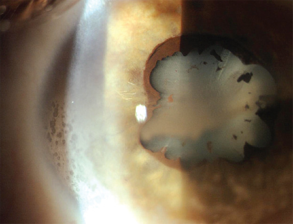 Juvenile idiopathic arthritis and associated uveitis: A review of pathogenesis, diagnosis, and management.
