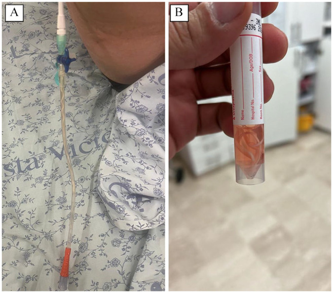 <i>Ascaris lumbricoides</i> Emerging from a PleurX Draining Catheter: An Unexpected Diagnosis.