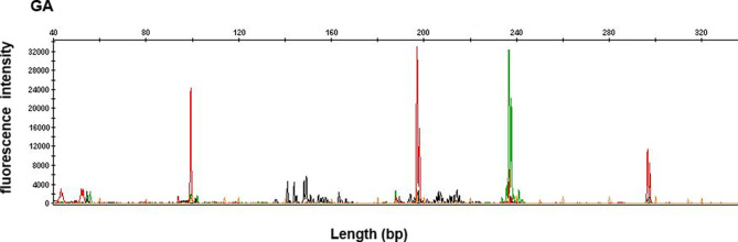 An exploratory study on the differential diagnostic indicators between adult systemic EBV-positive T-cell lymphoproliferative disorders and angioimmunoblastic T-cell lymphoma with multiple EBV infections.