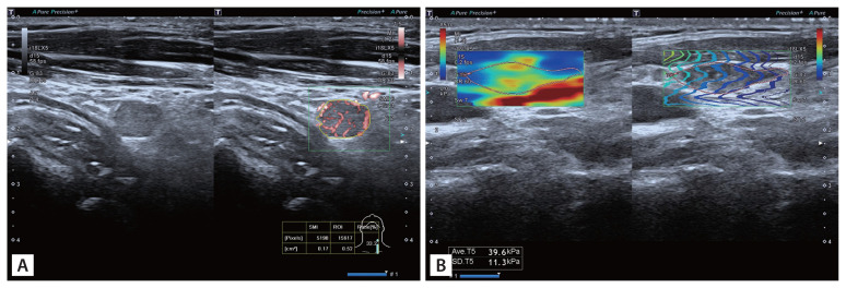 Fisher discriminant analysis of multimodal ultrasound in diagnosis of cervical metastatic lymph nodes in papillary thyroid cancer.