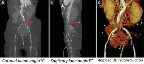 Stress Cardiomyopathy Complicated By Left Ventricular Thrombosis with Fatal Detachment.