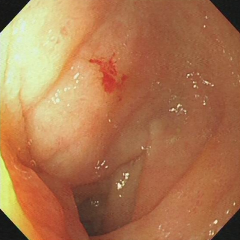 A rare complication of EUS-guided biliary drainage (with video).