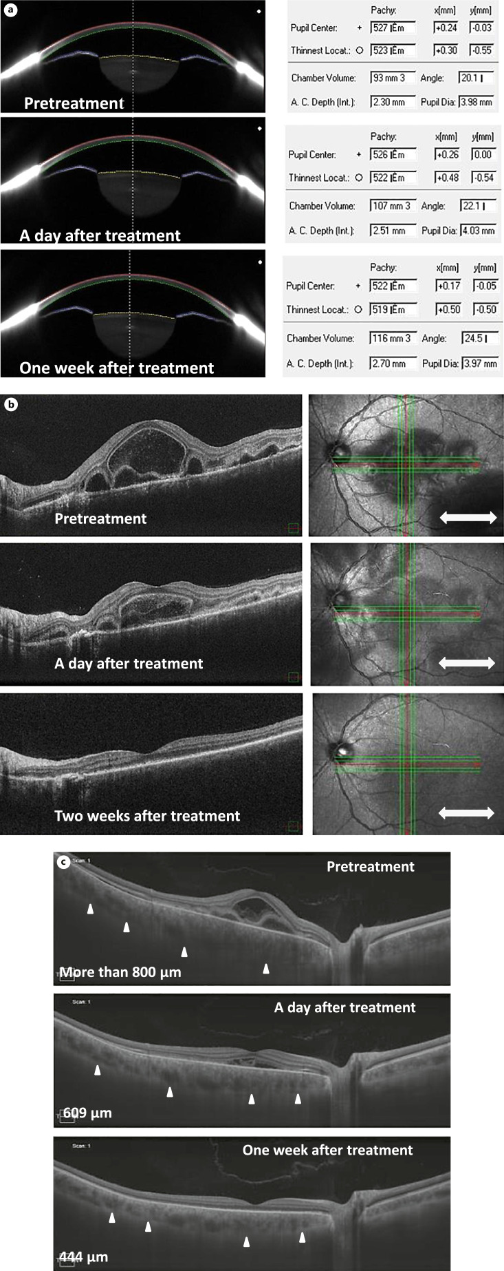 Early Changes in Ocular Biomarkers in Patients with Vogt-Koyanagi-Harada Disease after Pulse Steroid Therapy.