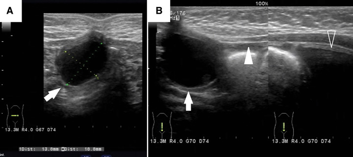 Coexisting Remnants of the Omphalomesenteric Duct and Urachus in an Infant.