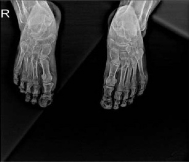 Calciphylaxis: A Mimic of Vasculitis.