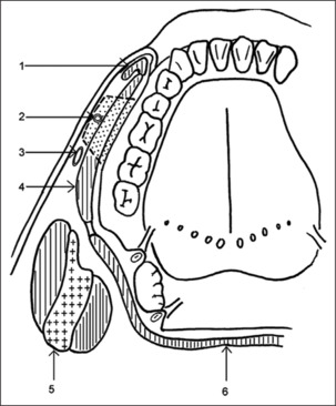 The outcomes of Facial Artery Musculomucosal (FAMM) flaps in oral oncologic reconstructions.