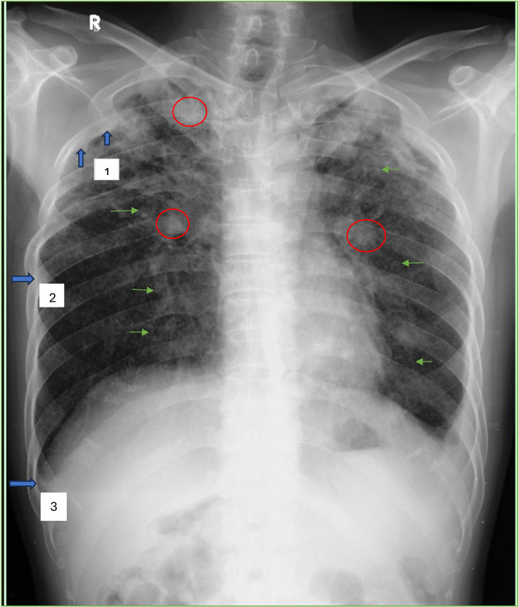Influences of radiographic silicosis and drug supervisor on the development of multi drug resistant-tuberculosis in West Java, Indonesia.