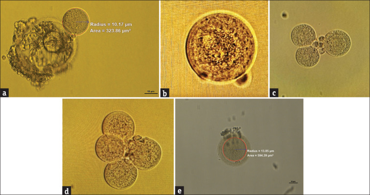 The Fate of Zona free Oocyte Following Intracytoplasmic Sperm Injection: A Case Report and Review of Literature.