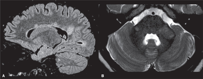 Hyperintense lesions of the middle cerebellar peduncle and beyond: a pictorial essay.