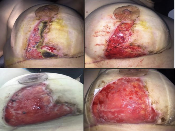 Pyoderma Gangrenosum: A Nightmare for Breast Surgery-Two Case Reports.