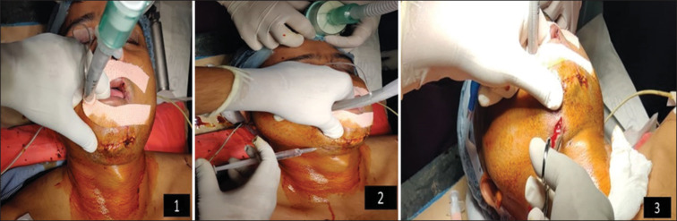 A new safer method for extubating patients of submental intubation - A case report.