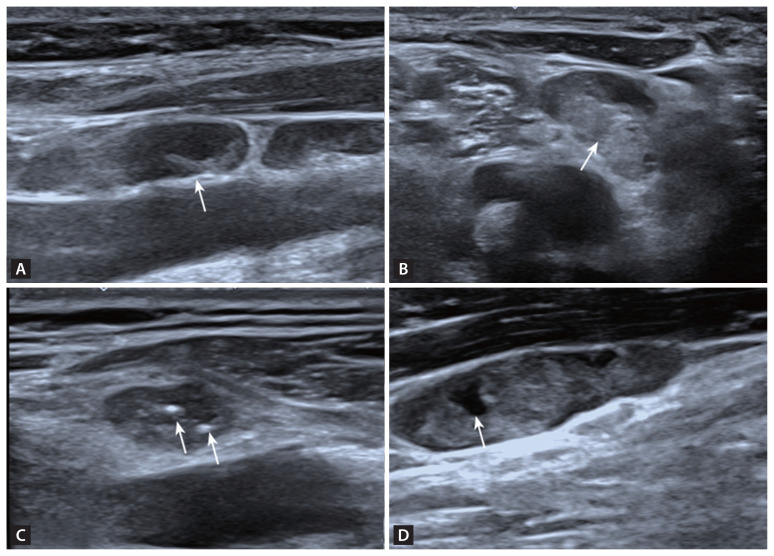 Fisher discriminant analysis of multimodal ultrasound in diagnosis of cervical metastatic lymph nodes in papillary thyroid cancer.