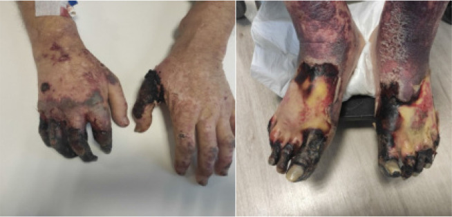 Calciphylaxis: A Mimic of Vasculitis.