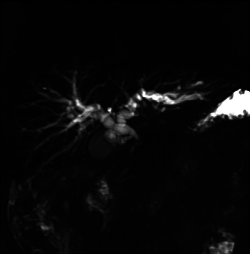 A rare complication of EUS-guided biliary drainage (with video).