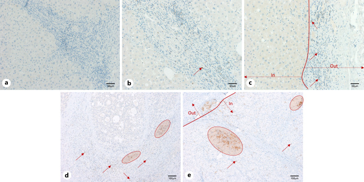 Immuno-Activated, Highly Expressing PD-1 Phenotype in Hepatocellular Carcinoma Is Associated with a Lower Recurrence Rate.