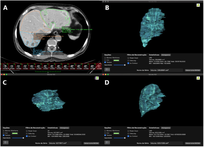 Correlation between liver volume drainage and clinical success after endoscopic biliary drainage of hilar malignant obstruction