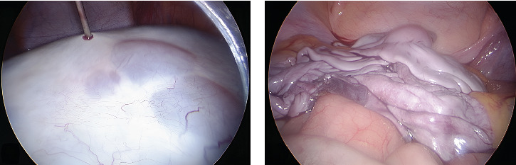An Adolescent With a Giant Ovarian Cyst and Hyperandrogenism: Case Report.
