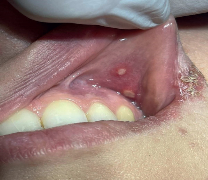 Clinical Evaluation and Microbiological Identification of Helicobacter Pylori in Patients with Oral Ulcerations Using the Polymerase Chain Reaction (PCR) Method.