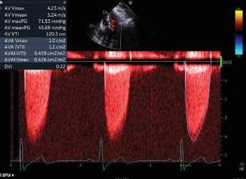 Anomalous Right Coronary Artery: Culprit or Innocent Bystander?