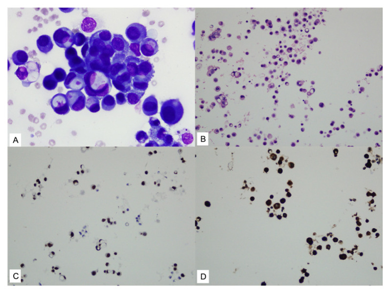 Cytopathological evaluation of pericardial effusions: 192 cases from a tertiary-level healthcare center.