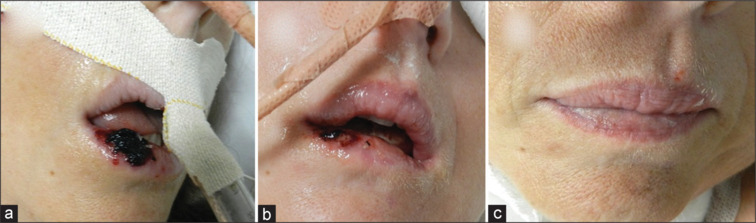 Medical device-related orofacial ulcers: Report of two cases managed with photobiomodulation therapy.