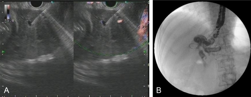 A rare complication of EUS-guided biliary drainage (with video).