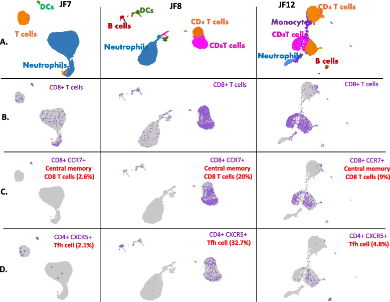 Joint fluid multi-omics improves diagnostic confidence during evaluation of children with presumed septic arthritis.