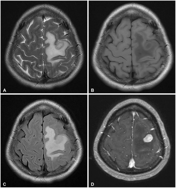 A Rare Case of Isolated Central Nervous System Neoplasm With Histiocytic Features.
