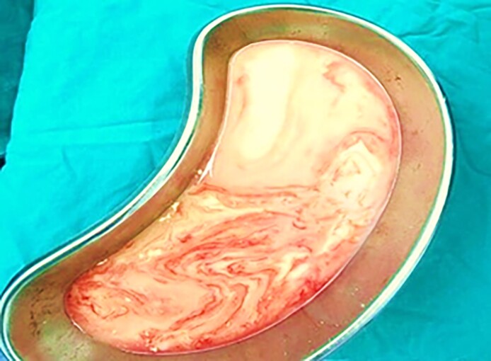 Galactocele Following Aesthetic Breast Augmentation: Diagnosis, Management, and Prevention.