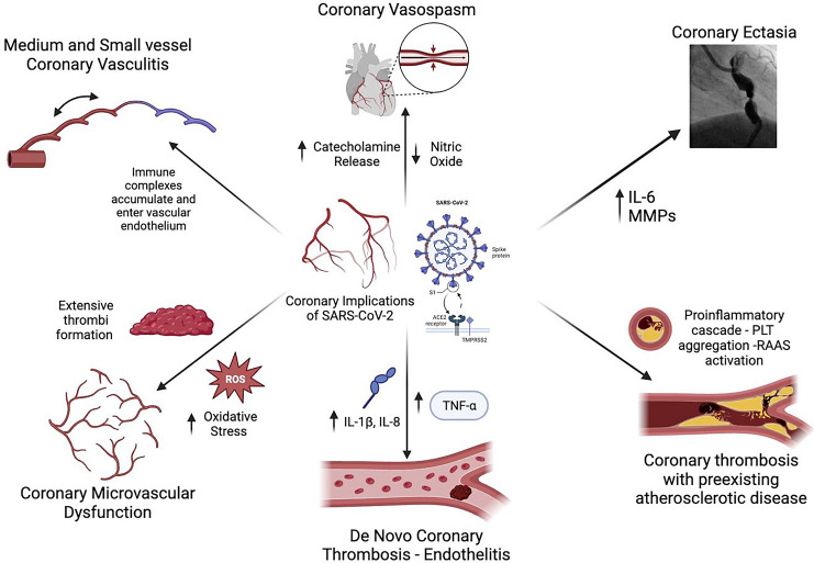 Coronary Implications of COVID-19.
