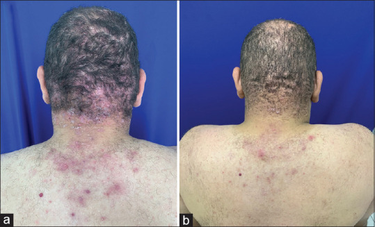 Refractory Folliculitis Decalvans: New Therapeutic Horizons?